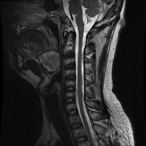 File:Neurofibromatosis type 2 (Radiopaedia 44936-48837 Sagittal T2 8).png