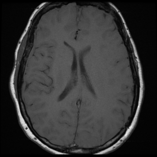 File:Neurofibromatosis type 2 (Radiopaedia 45229-49251 Axial T1 21).png