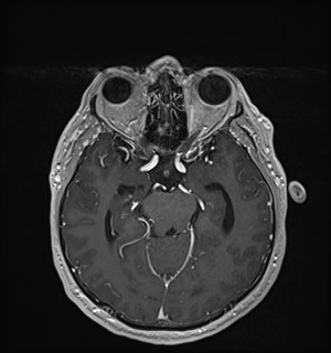 Neurofibromatosis type 2 (Radiopaedia 79097-92049 Axial T1 C+ 84).jpg
