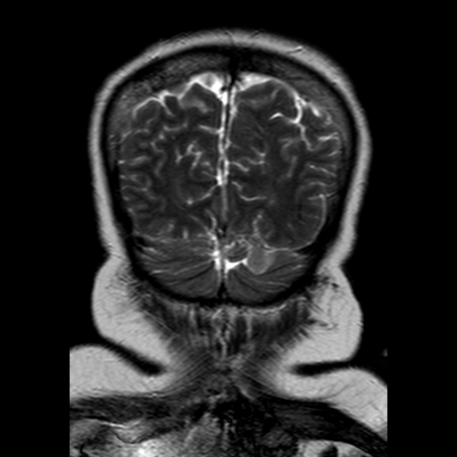 File:Neurofibromatosis type 2 (Radiopaedia 8713-9518 Coronal T2 22).jpg