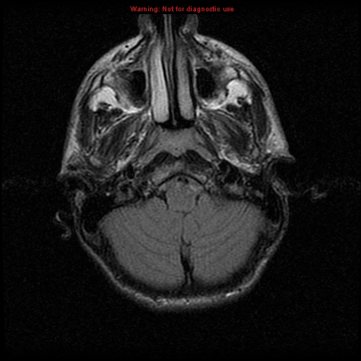 File:Neurofibromatosis type 2 (Radiopaedia 8953-9730 Axial FLAIR 6).jpg