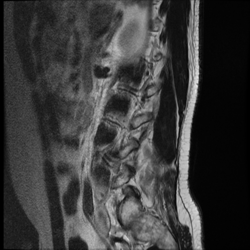 File:Neurofibromatosis type 2 (spinal manifestations) (Radiopaedia 53943-60070 E 2).png