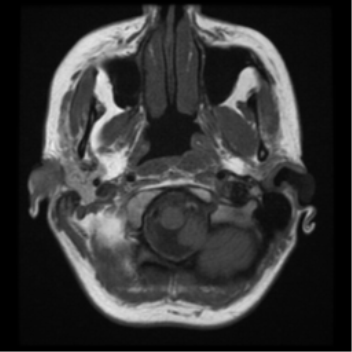 File:Neurofibromatosis type 2 - bilateral acoustic neuromata (Radiopaedia 40060-42566 Axial T1 1).png