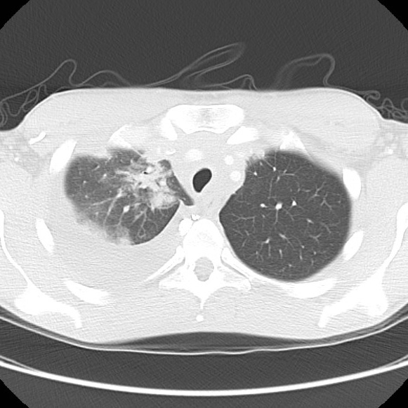 File:Non-Hodgkin lymphoma involving lung (Radiopaedia 29094-29470 Axial lung window 18).jpg