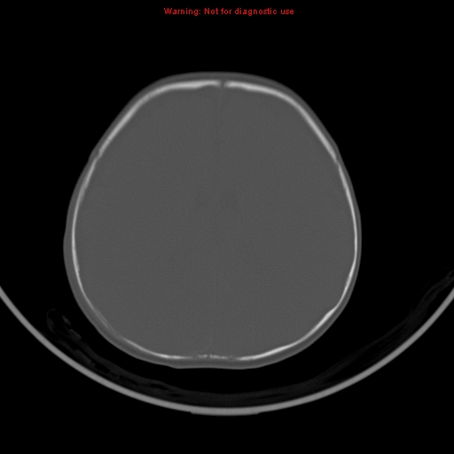 File:Non-accidental injury - bilateral subdural with acute blood (Radiopaedia 10236-10765 Axial bone window 15).jpg
