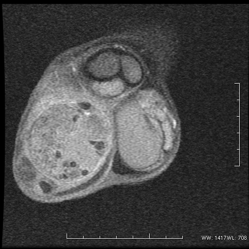 File:Non-seminomatous germ cell tumor (Radiopaedia 16649-16352 Coronal T1 C+ 4).png