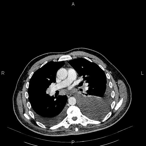 File:Non Hodgkin lymphoma in a patient with ankylosing spondylitis (Radiopaedia 84323-99621 B 17).jpg