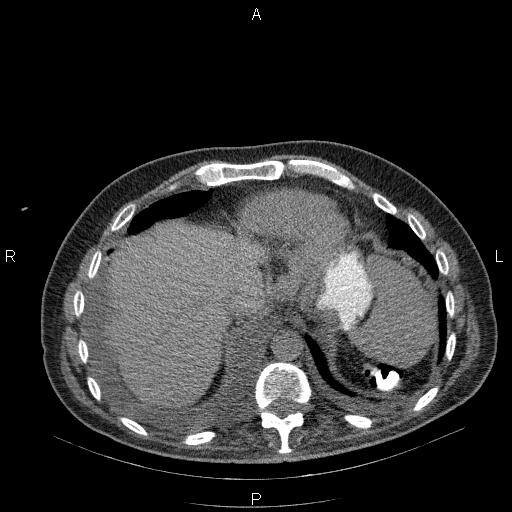 File:Non Hodgkin lymphoma in a patient with ankylosing spondylitis (Radiopaedia 84323-99624 Axial non-contrast 28).jpg