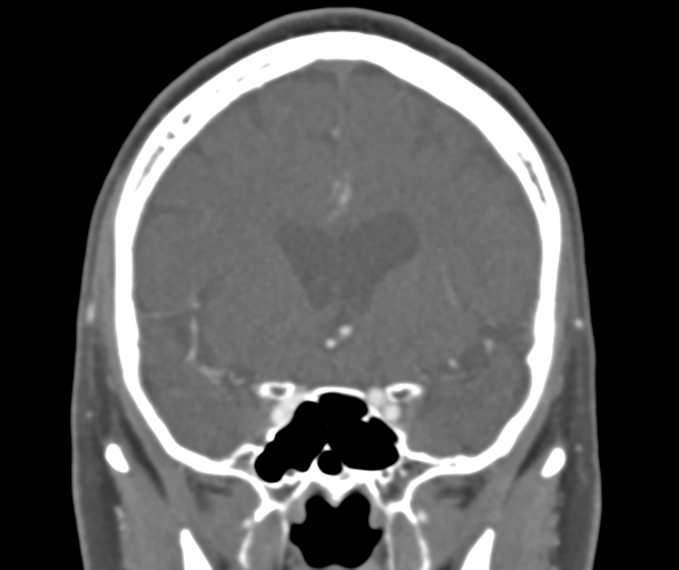 File:Normal CTA head (Radiopaedia 40801-43464 B 40).png