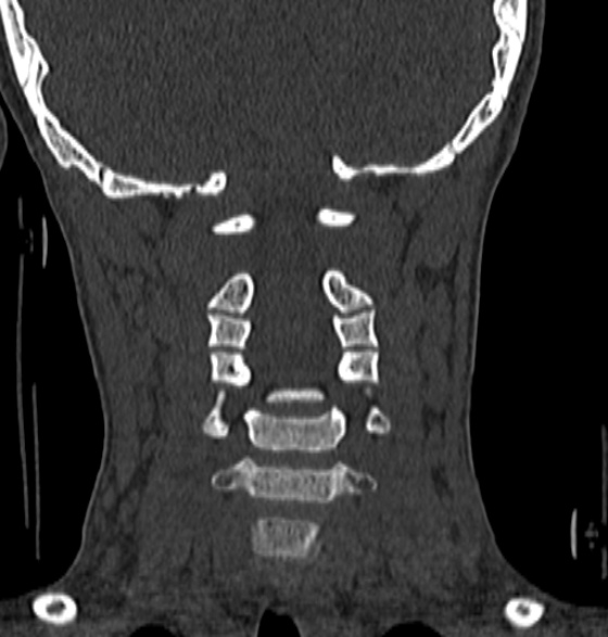File:Normal CT cervical spine - 12-year-old (Radiopaedia 55352-61775 Coronal bone window 114).jpg
