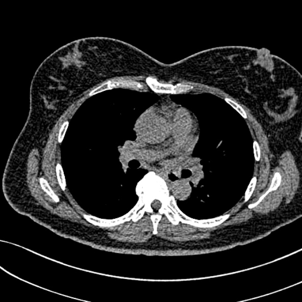 Normal CT chest- adult female (Radiopaedia 52522-58428 Axial non-contrast 64).jpg