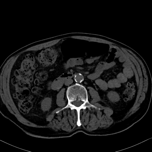 File:Normal CT intravenous cholangiogram (Radiopaedia 38199-40208 Axial IVC 61).png