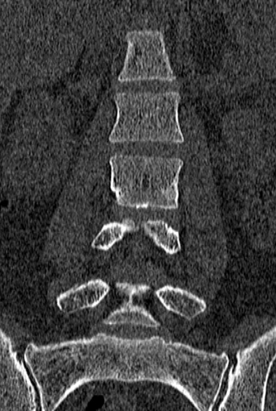 Normal CT lumbar spine (Radiopaedia 53981-60118 Coronal bone window 27).jpg