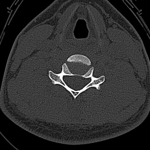 File:Normal CT of the cervical spine (Radiopaedia 53322-59305 Axial bone window 172).jpg