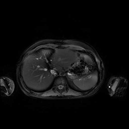 File:Normal MRI abdomen in pregnancy (Radiopaedia 88001-104541 D 9).jpg