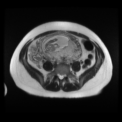 Normal MRI abdomen in pregnancy (Radiopaedia 88003-104546 Axial T2 28).jpg