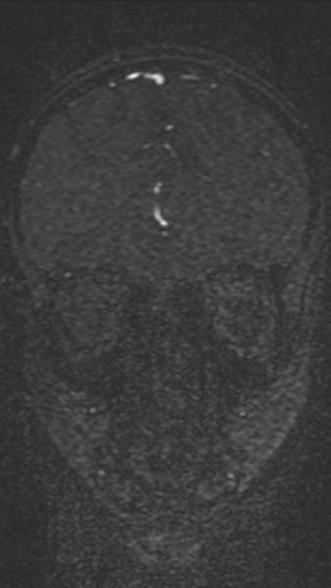 Normal MRI brain with MRV- teenager (Radiopaedia 49425-54553 Coronal MRV 78).jpg