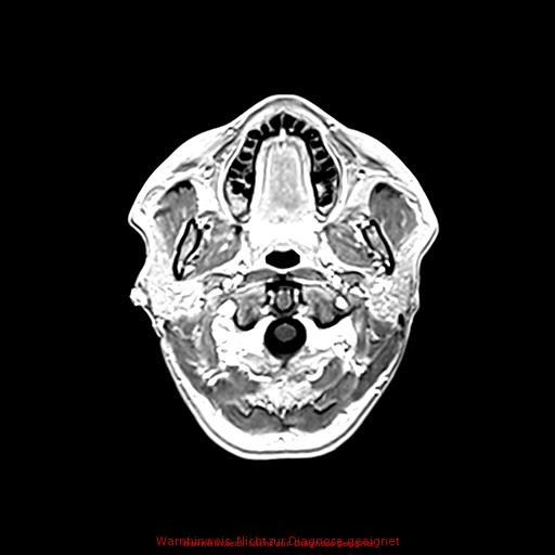 Normal adult brain MRI (non-enhanced and contrast-enhanced) (Radiopaedia 75262-86379 Axial T1 C+ 32).jpg