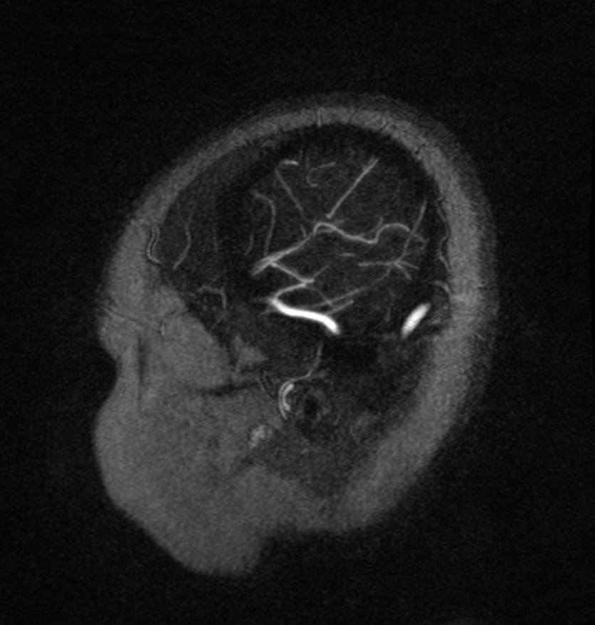 Normal brain MRI and venogram (Radiopaedia 39554-41862 Sagittal MRV 63).jpg