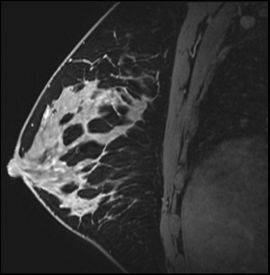 Normal breast MRI - dense breasts (Radiopaedia 80454-93850 I 109).jpg