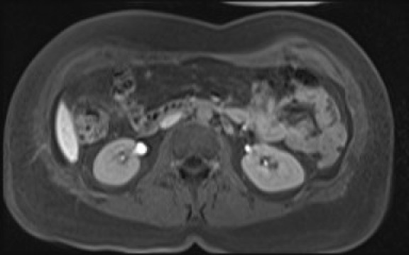 File:Normal hepatobiliary phase liver MRI (Radiopaedia 58968-66230 A 68).jpg