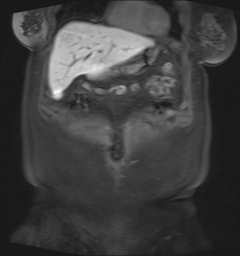 File:Normal hepatobiliary phase liver MRI (Radiopaedia 58968-66230 B 42).jpg