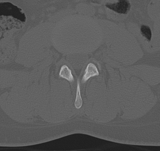 File:Normal lumbar spine CT (Radiopaedia 46533-50986 Axial bone window 41).png