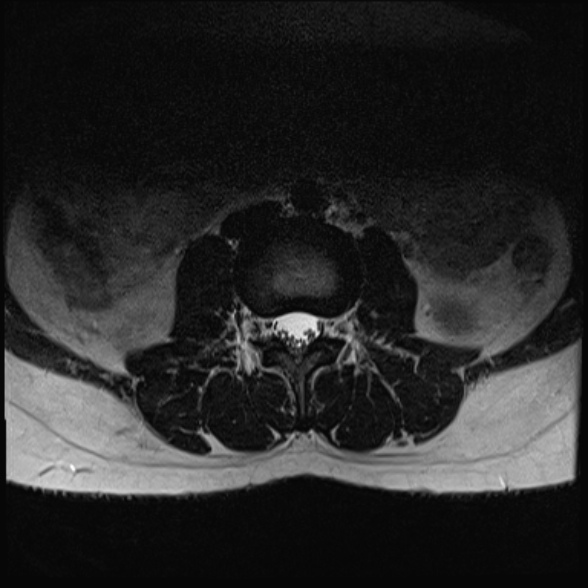 File:Normal lumbar spine MRI- 3 T (Radiopaedia 53280-59250 Axial T2 7).jpg