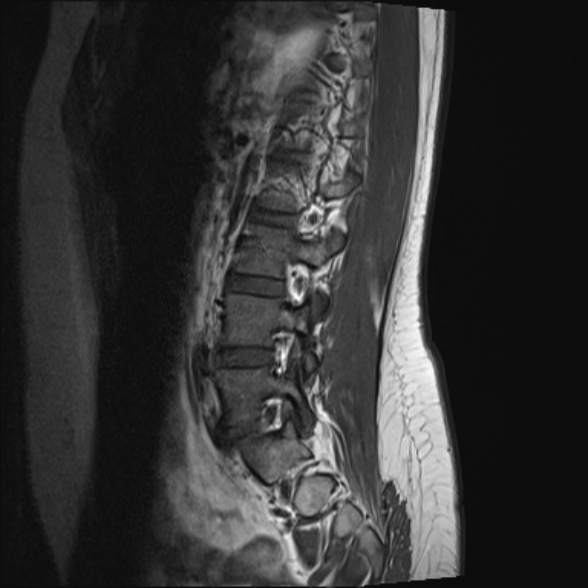 File:Normal lumbar spine MRI- 3 T (Radiopaedia 53280-59250 Sagittal T1 18).jpg