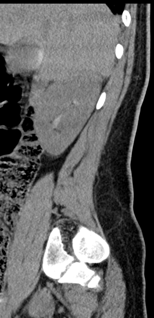 Normal lumbosacral CT (Radiopaedia 37923-39867 E 93).png