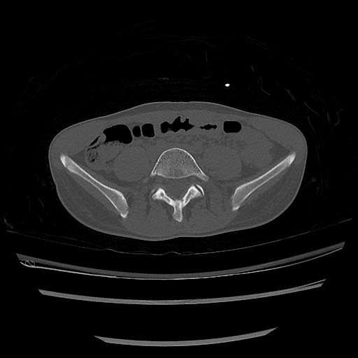 Normal pelvis CT (Radiopaedia 51471-57236 Axial bone window 11).jpg