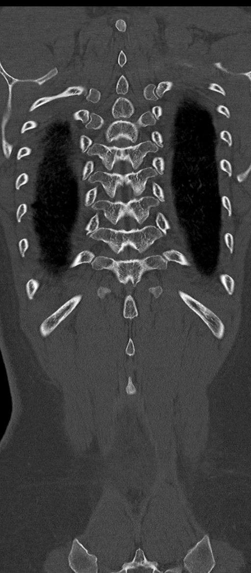 Normal thoracolumbar spine (Radiopaedia 43822-47309 Coronal bone window 77).png