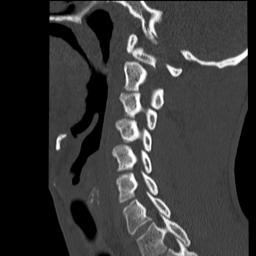 File:Normal trauma cervical spine (Radiopaedia 41017-43760 Sagittal bone window 15).png
