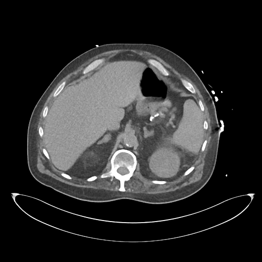 File:Obstructive pyelonephritis (Radiopaedia 46411-50844 Axial non-contrast 22).png
