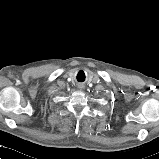 File:Obstructive superior vena cava tumor thrombus (Radiopaedia 28046-28306 A 2).jpg