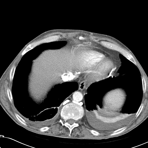 File:Obstructive superior vena cava tumor thrombus (Radiopaedia 28046-28306 A 45).jpg