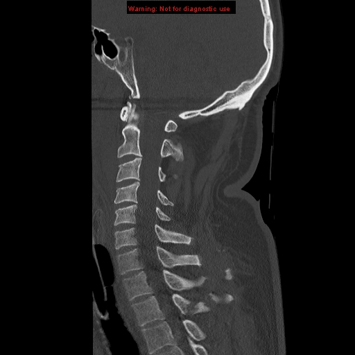 File:Occipital condyle fracture (Radiopaedia 18366-18208 Sagittal bone window 16).jpg
