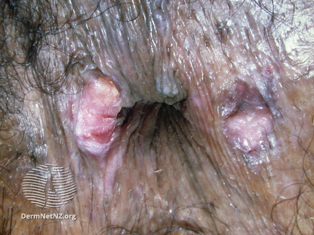 File:Peri-anal squamous cell carcinoma in situ (DermNet NZ site-age-specific-ain-2).jpg