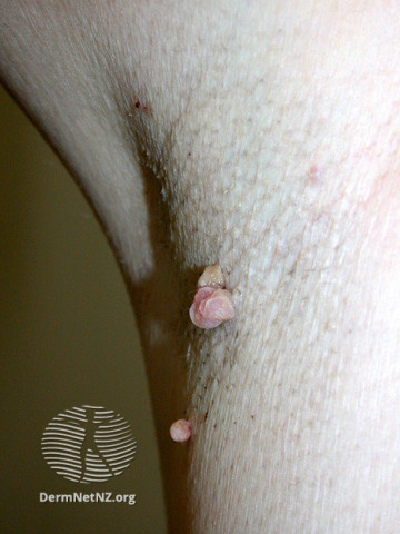 File:Skin tag (DermNet NZ lesions-tag2).jpg