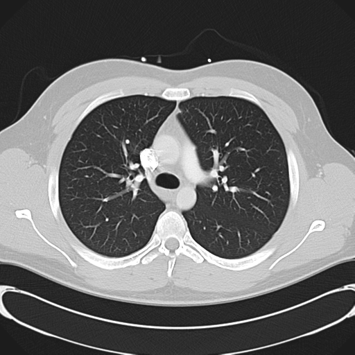 File:'Bovine' aortic arch (Radiopaedia 33554-34637 Axial lung window 22).png