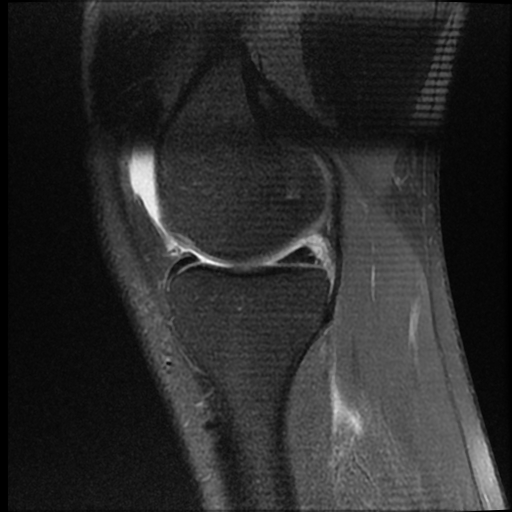 File:ACL acute full thickness tear - deep lateral femoral sulcus sign (Radiopaedia 38594-40740 Sagittal PD fat sat 7).jpg