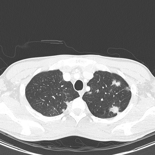 AIDS-related Kaposi sarcoma (Radiopaedia 85247-100811 Axial lung window 29).jpg