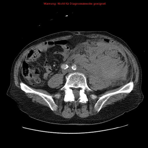 File:Abdominal aortic aneurysm- extremely large, ruptured (Radiopaedia 19882-19921 Axial C+ arterial phase 49).jpg