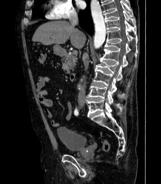 Abdominal aortic aneurysm (Radiopaedia 25855-26001 Sagittal C+ arterial phase 20).jpg