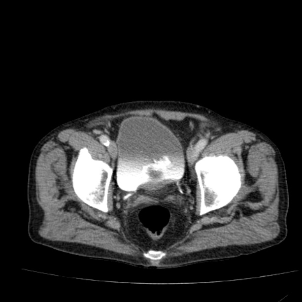 Abdominal aortic aneurysm (Radiopaedia 29248-29660 Axial C+ portal venous phase 56).jpg