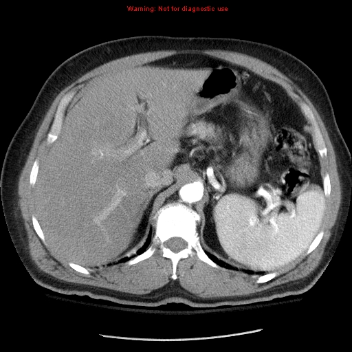 Abdominal aortic aneurysm (Radiopaedia 8190-9038 Axial C+ arterial phase 22).jpg