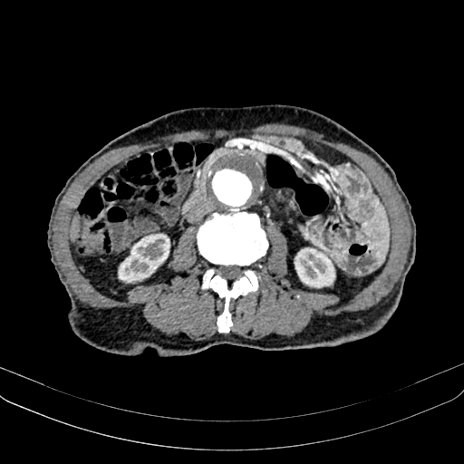 Abdominal aortic aneurysm (Radiopaedia 83581-98689 Axial C+ arterial phase 62).jpg