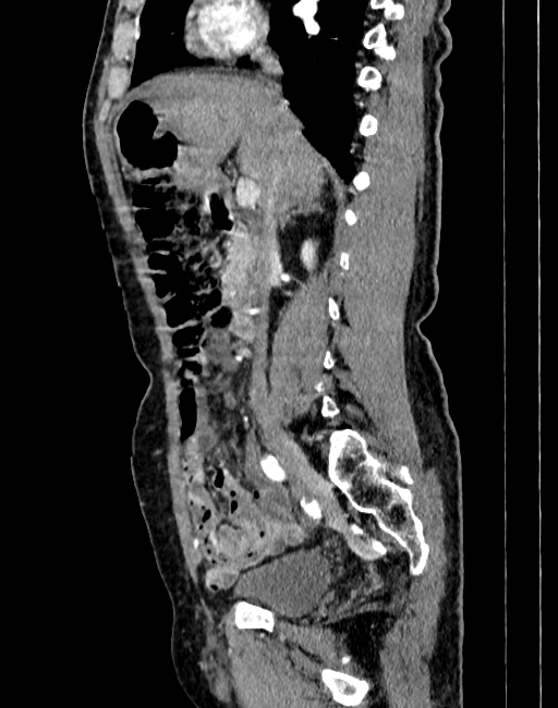 Abdominal aortic aneurysm (Radiopaedia 83581-98689 Sagittal C+ arterial phase 20).jpg
