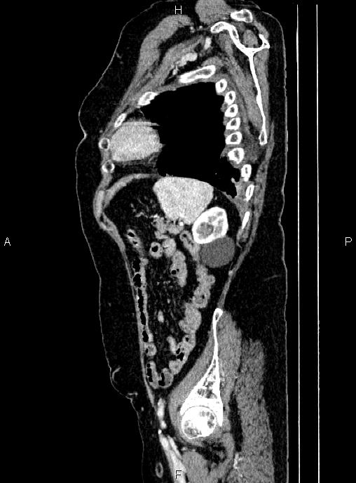 Abdominal aortic aneurysm (Radiopaedia 85063-100606 Sagittal C+ arterial phase 67).jpg