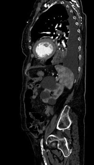 Abdominal aortic aneurysm with thrombus fissuration (Radiopaedia 73192-83919 Sagittal C+ arterial phase 33).jpg